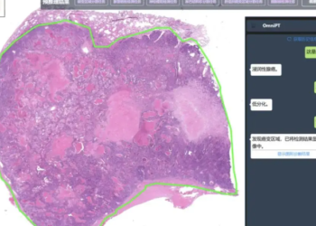 AI Tool OmniPT enhances cancer diagnosis in China