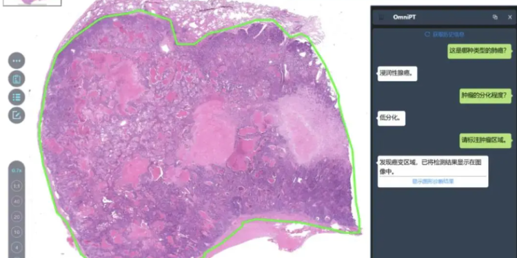 AI Tool OmniPT enhances cancer diagnosis in China
